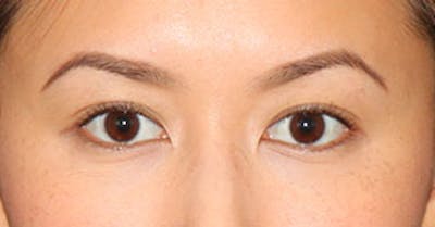 Asian (Double) Eyelid Before & After Gallery - Patient 3869599 - Image 2