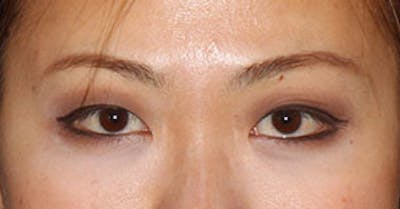 Asian (Double) Eyelid Before & After Gallery - Patient 3869604 - Image 1