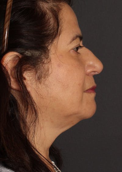 Facetite Before & After Gallery - Patient 3869608 - Image 2