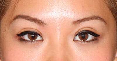 Asian (Double) Eyelid Before & After Gallery - Patient 3869605 - Image 2