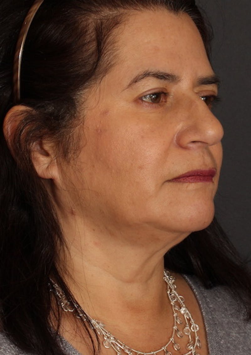 Facetite Before & After Gallery - Patient 3869608 - Image 4