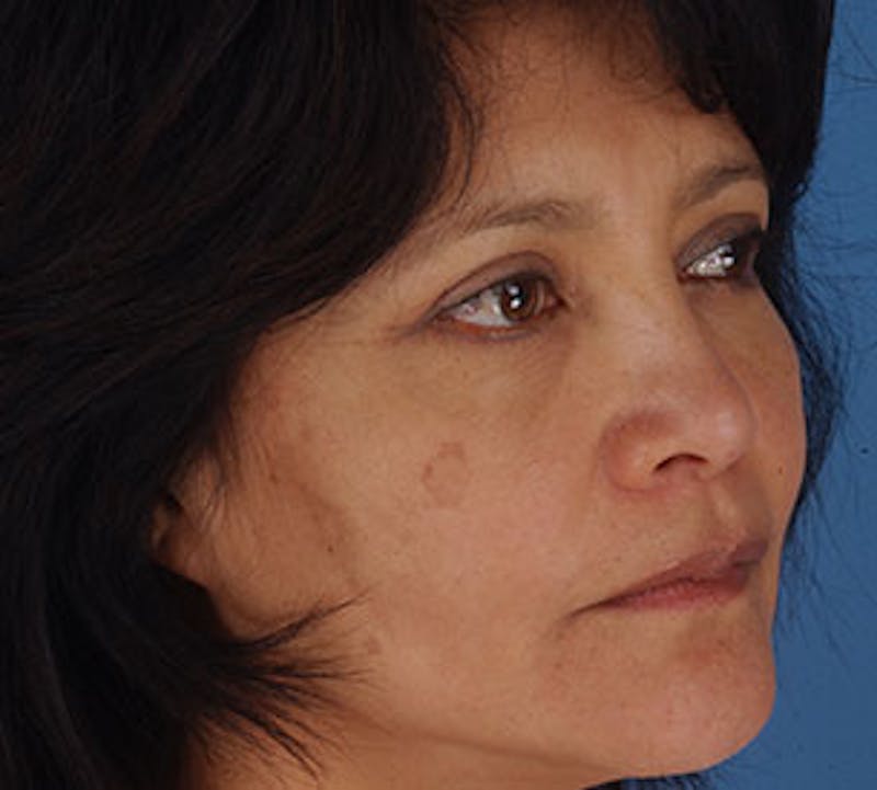 Browlift/Upper Blepharoplasty Before & After Gallery - Patient 3869607 - Image 6