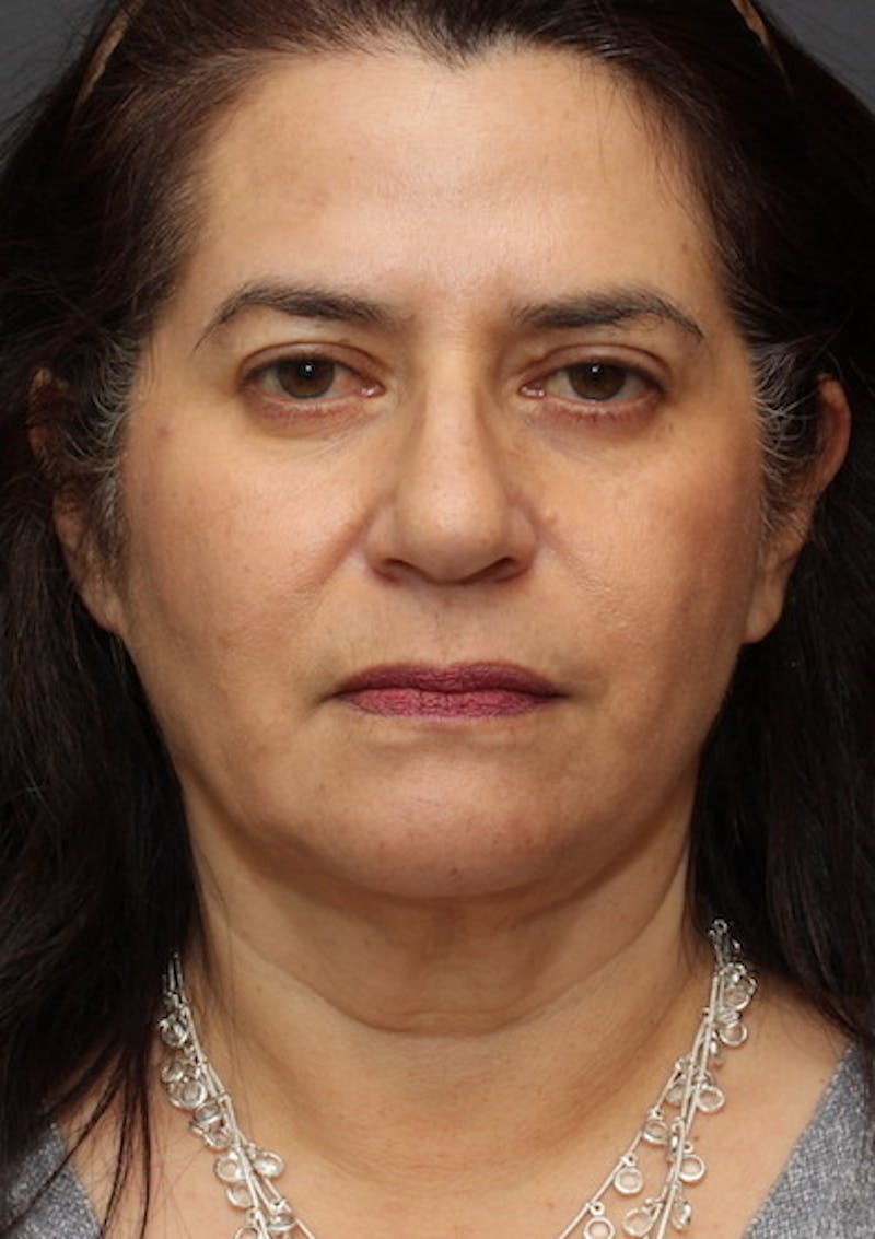 Facetite Before & After Gallery - Patient 3869608 - Image 6