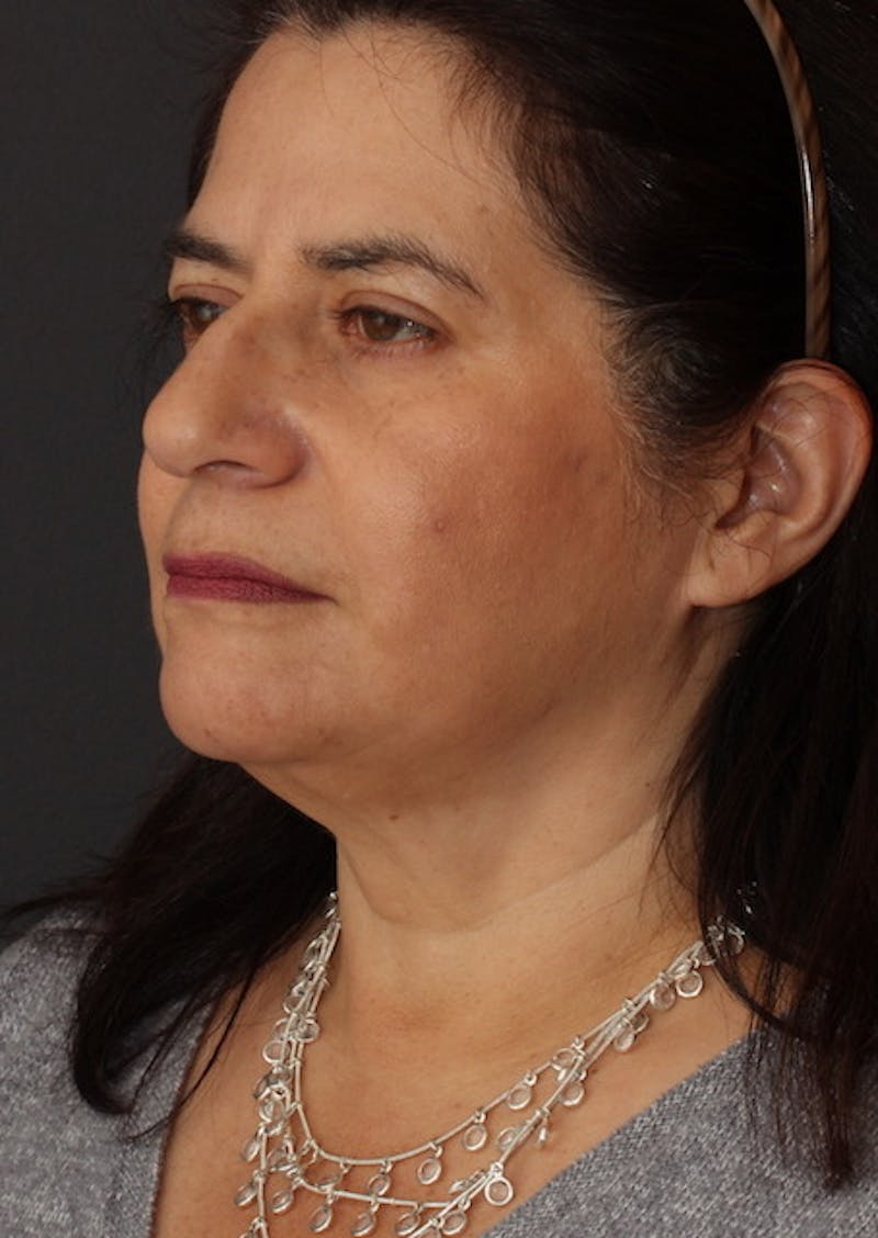 Facetite Before & After Gallery - Patient 3869608 - Image 8