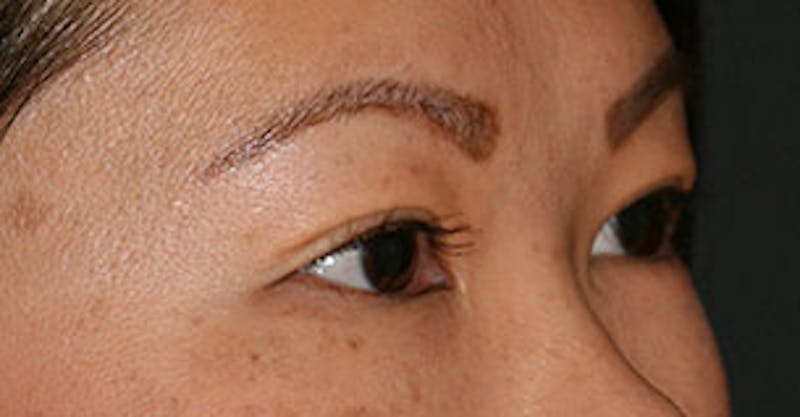 Asian (Double) Eyelid Before & After Gallery - Patient 3869609 - Image 4