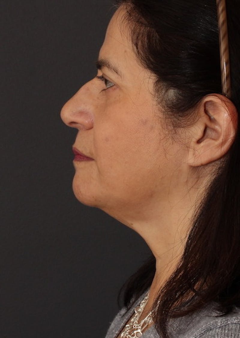 Facetite Before & After Gallery - Patient 3869608 - Image 10