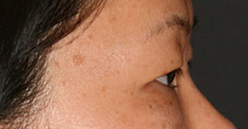 Asian (Double) Eyelid Before & After Gallery - Patient 3869609 - Image 7