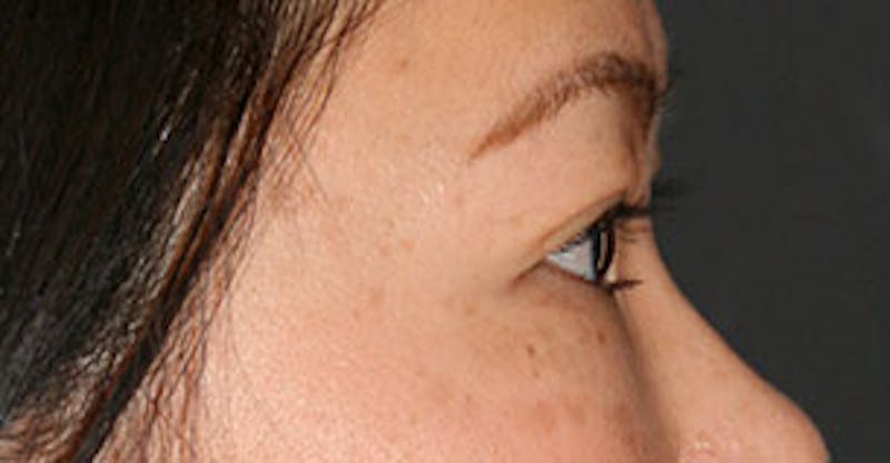 Asian (Double) Eyelid Before & After Gallery - Patient 3869609 - Image 8
