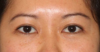 Asian (Double) Eyelid Before & After Gallery - Patient 3869611 - Image 2