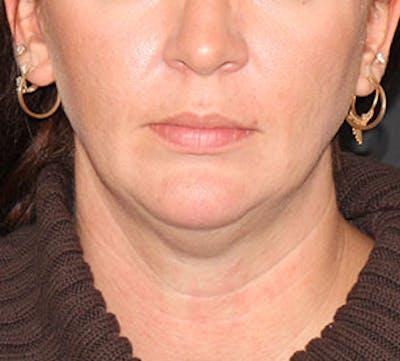 Neck Liposuction Before & After Gallery - Patient 3869617 - Image 1