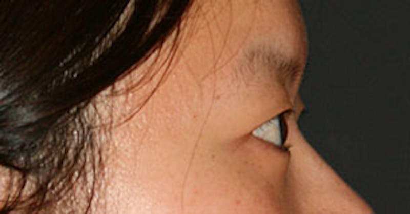 Asian (Double) Eyelid Before & After Gallery - Patient 3869616 - Image 7