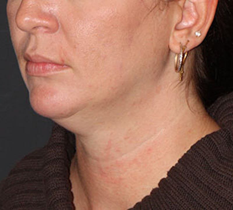 Neck Liposuction Before & After Gallery - Patient 3869617 - Image 5