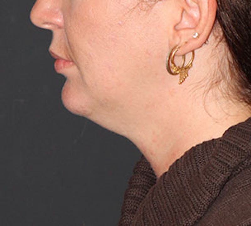 Neck Liposuction Before & After Gallery - Patient 3869617 - Image 9