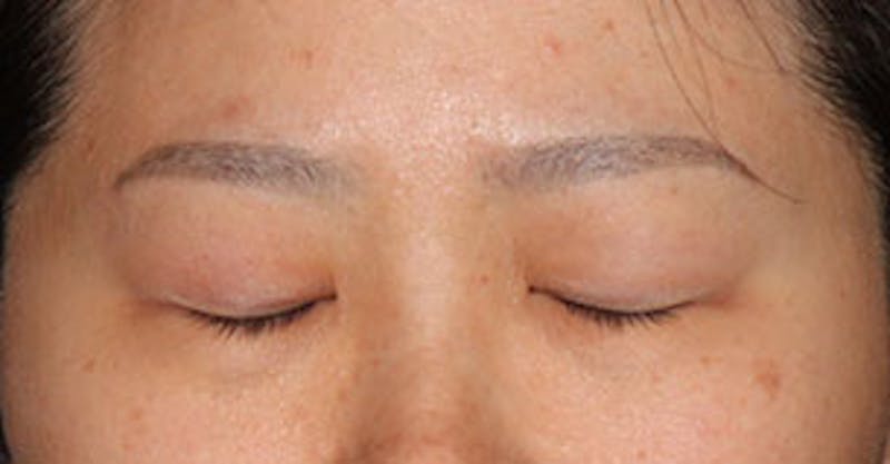 Asian (Double) Eyelid Before & After Gallery - Patient 3869619 - Image 3