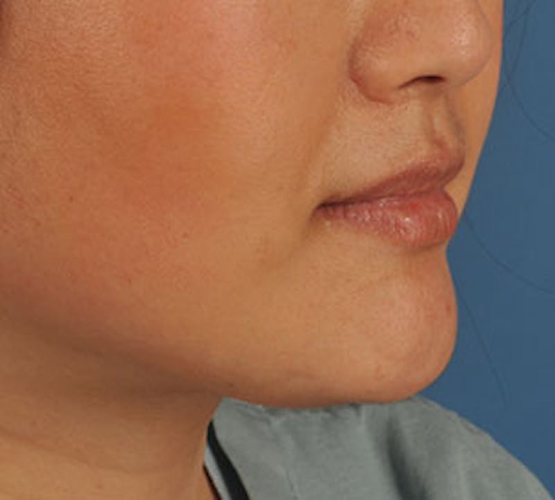 Lip Enhancement Before & After Gallery - Patient 3869623 - Image 3