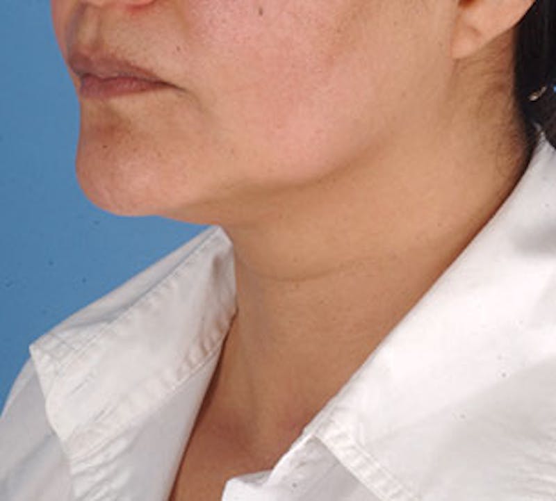 Neck Liposuction Before & After Gallery - Patient 3869622 - Image 5