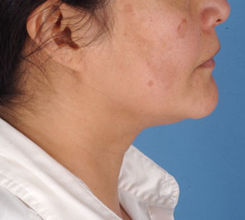 Neck Liposuction Before & After Gallery - Patient 3869622 - Image 7