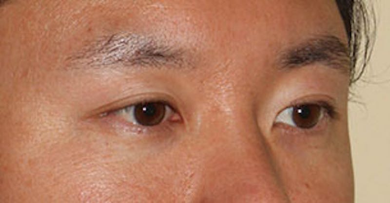 Asian (Double) Eyelid Before & After Gallery - Patient 3869624 - Image 4