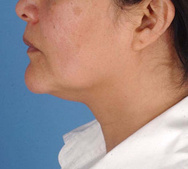 Neck Liposuction Before & After Gallery - Patient 3869622 - Image 9
