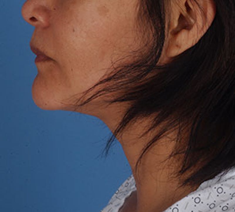 Neck Liposuction Before & After Gallery - Patient 3869622 - Image 10