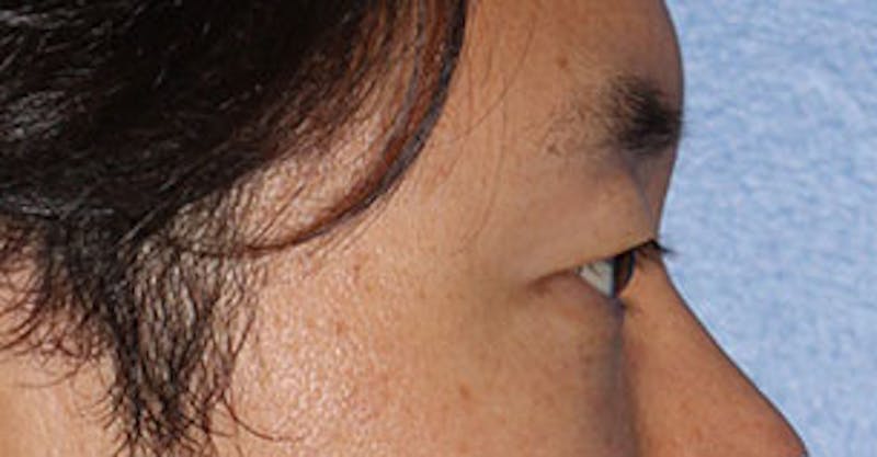 Asian (Double) Eyelid Before & After Gallery - Patient 3869624 - Image 7