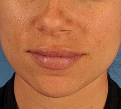 Lip Enhancement Before & After Gallery - Patient 3869626 - Image 2