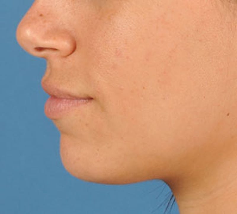 Lip Enhancement Before & After Gallery - Patient 3869626 - Image 11