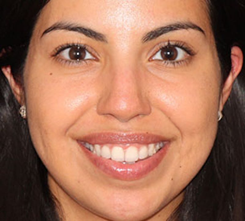 Lip Enhancement Before & After Gallery - Patient 3869630 - Image 2