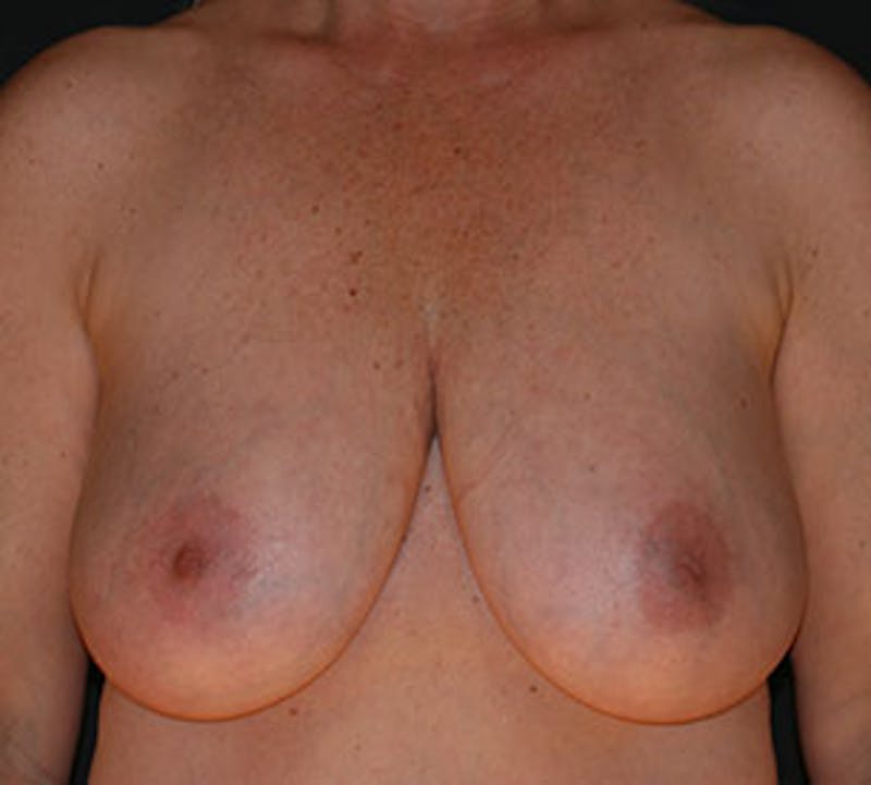 Breast Reduction and Mastopexy (Lift) Before & After Gallery - Patient 3869632 - Image 1