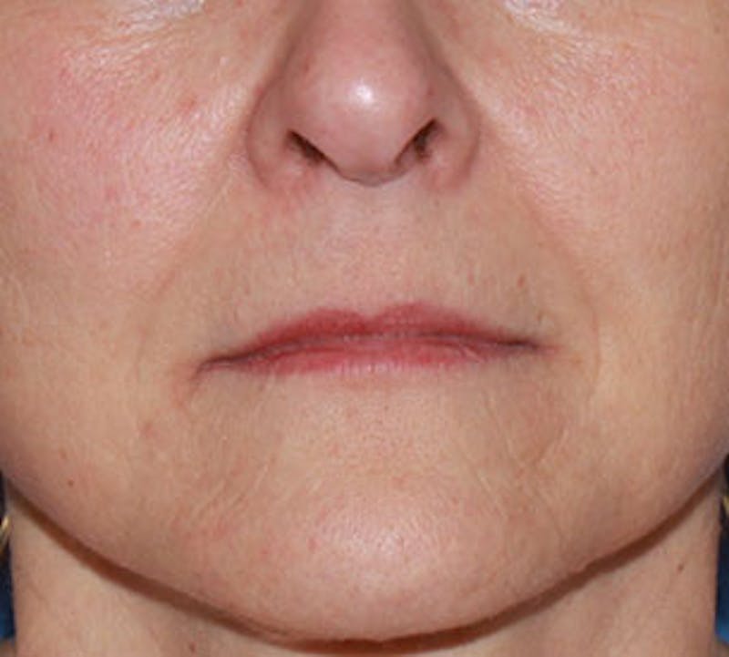 Lip Enhancement Before & After Gallery - Patient 3869639 - Image 3