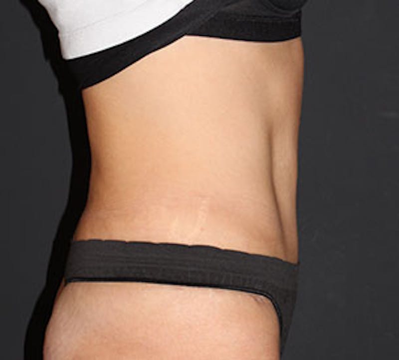 Abdominoplasty (Tummy Tuck) Before & After Gallery - Patient 3869638 - Image 8