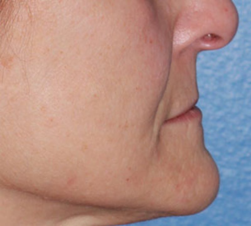 Lip Enhancement Before & After Gallery - Patient 3869639 - Image 9