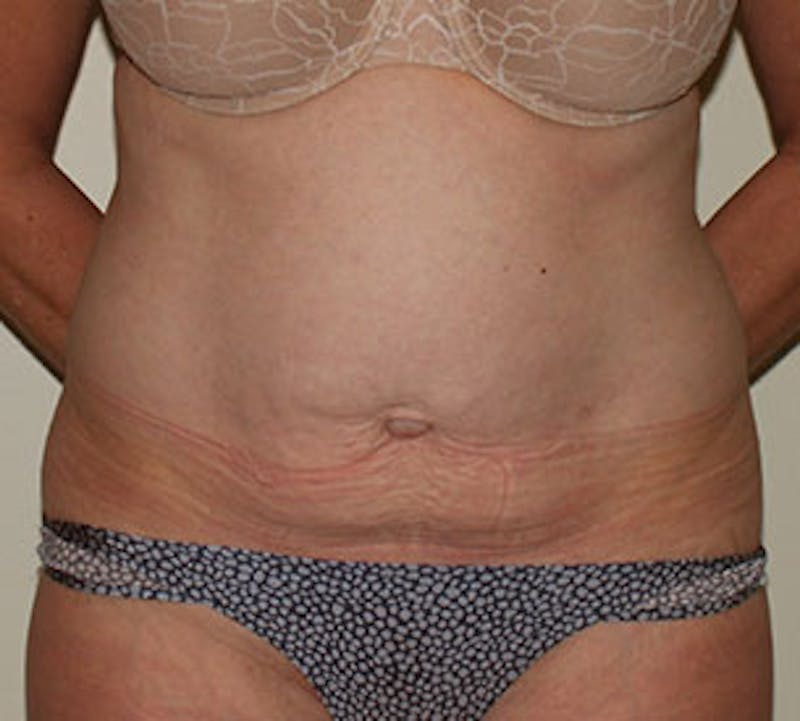 Abdominoplasty (Tummy Tuck) Before & After Gallery - Patient 3869643 - Image 1