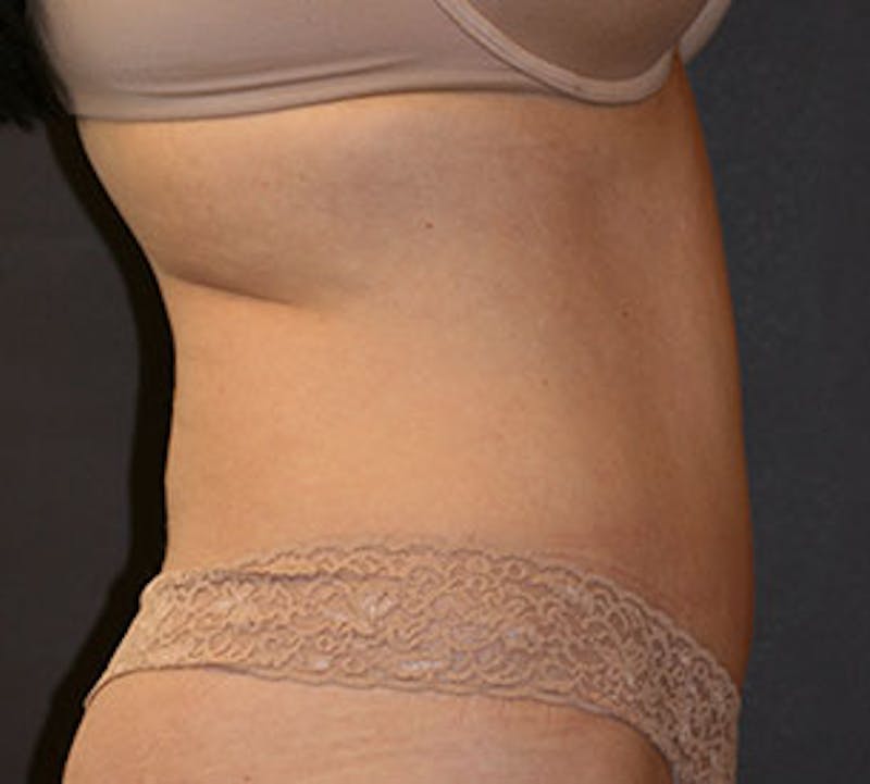 Abdominoplasty (Tummy Tuck) Before & After Gallery - Patient 3869649 - Image 6