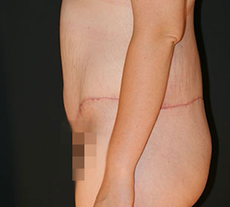After Weight Loss Before & After Gallery - Patient 3869650 - Image 6