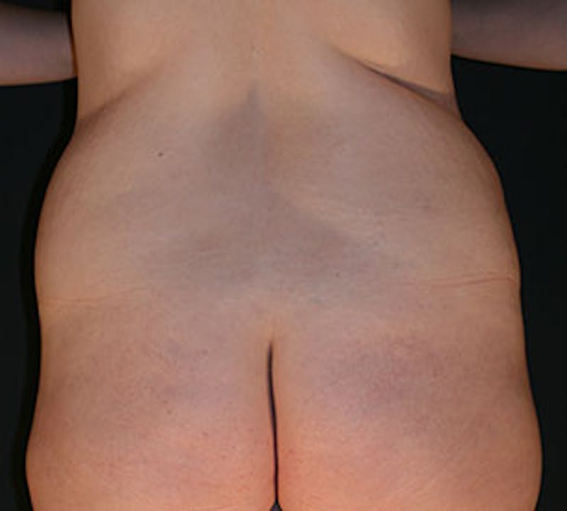 After Weight Loss Before & After Gallery - Patient 3869650 - Image 7