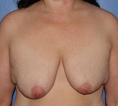 Augmentation-Mastopexy (Implant with Lift) Before & After Gallery - Patient 3891422 - Image 1