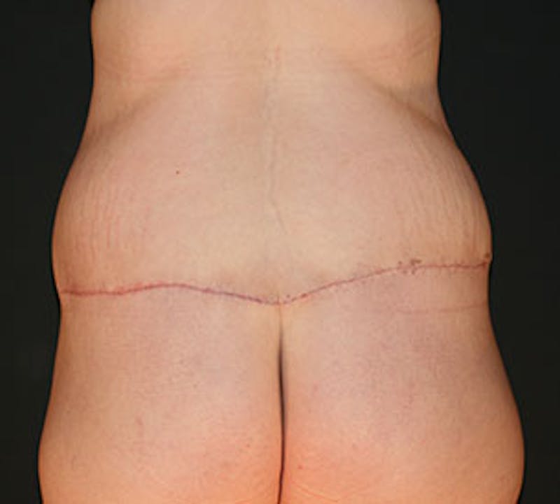 After Weight Loss Before & After Gallery - Patient 3869650 - Image 8