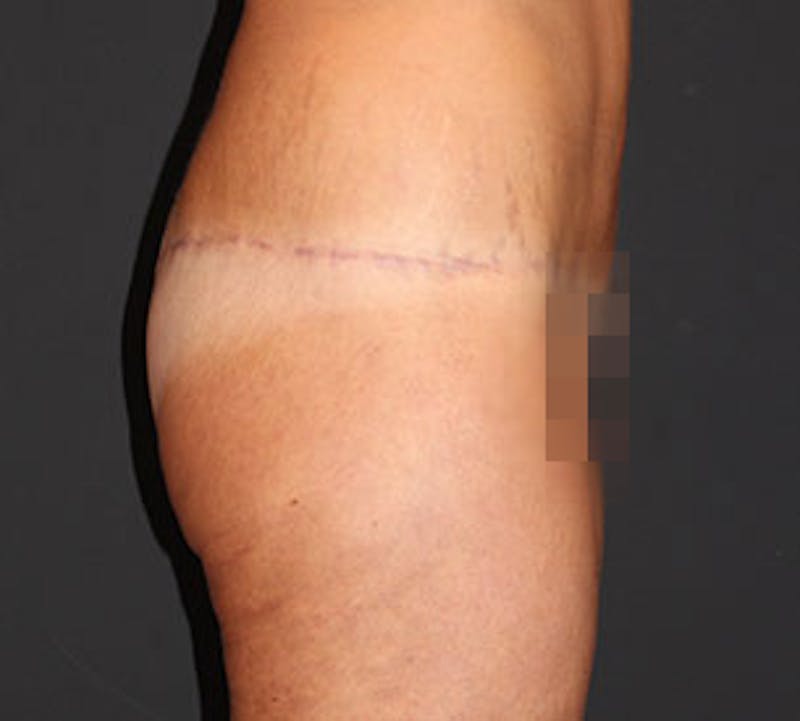 After Weight Loss Before & After Gallery - Patient 3891425 - Image 8