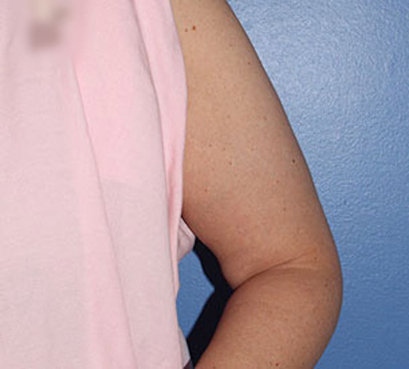 After Weight Loss Before & After Gallery - Patient 3891433 - Image 3