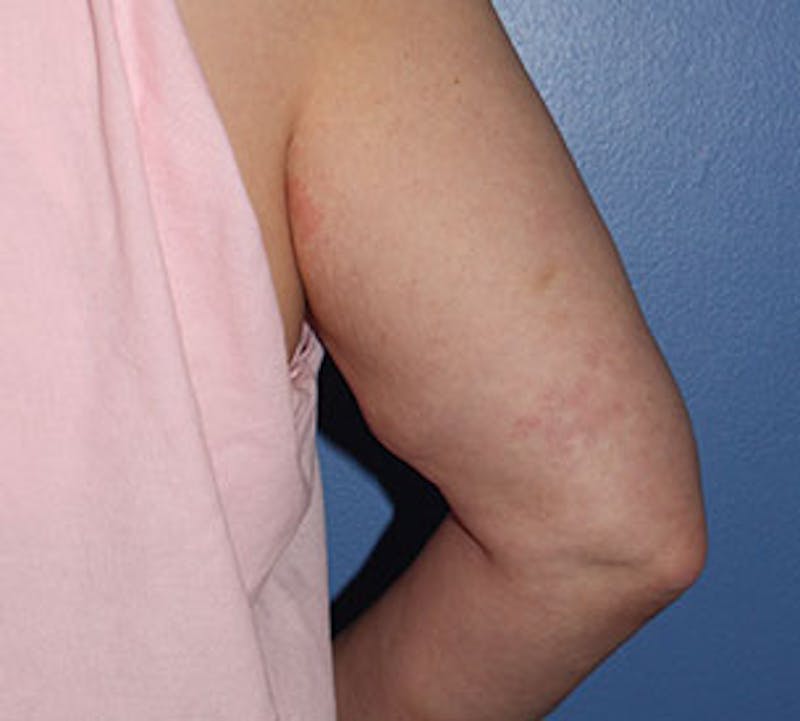 After Weight Loss Before & After Gallery - Patient 3891433 - Image 5