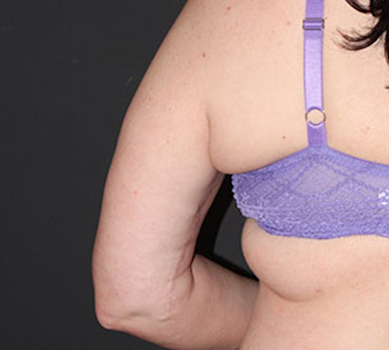 After Weight Loss Before & After Gallery - Patient 3891433 - Image 8