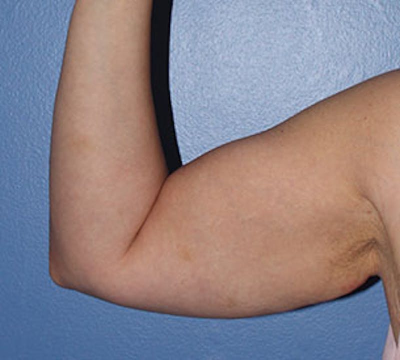 After Weight Loss Before & After Gallery - Patient 3891433 - Image 9