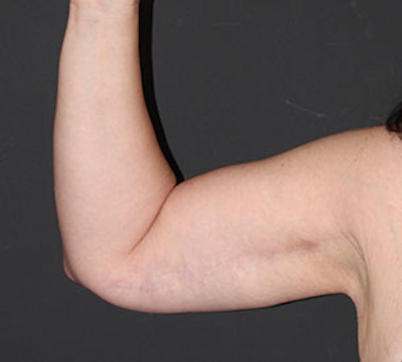 After Weight Loss Before & After Gallery - Patient 3891433 - Image 10