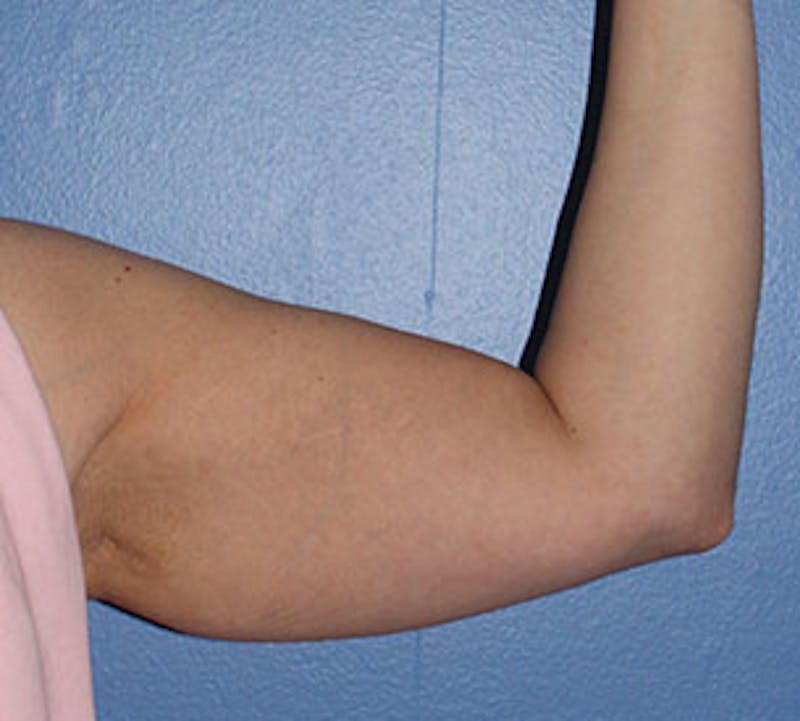 After Weight Loss Before & After Gallery - Patient 3891433 - Image 11