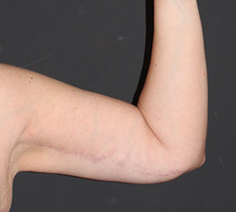 After Weight Loss Before & After Gallery - Patient 3891433 - Image 12