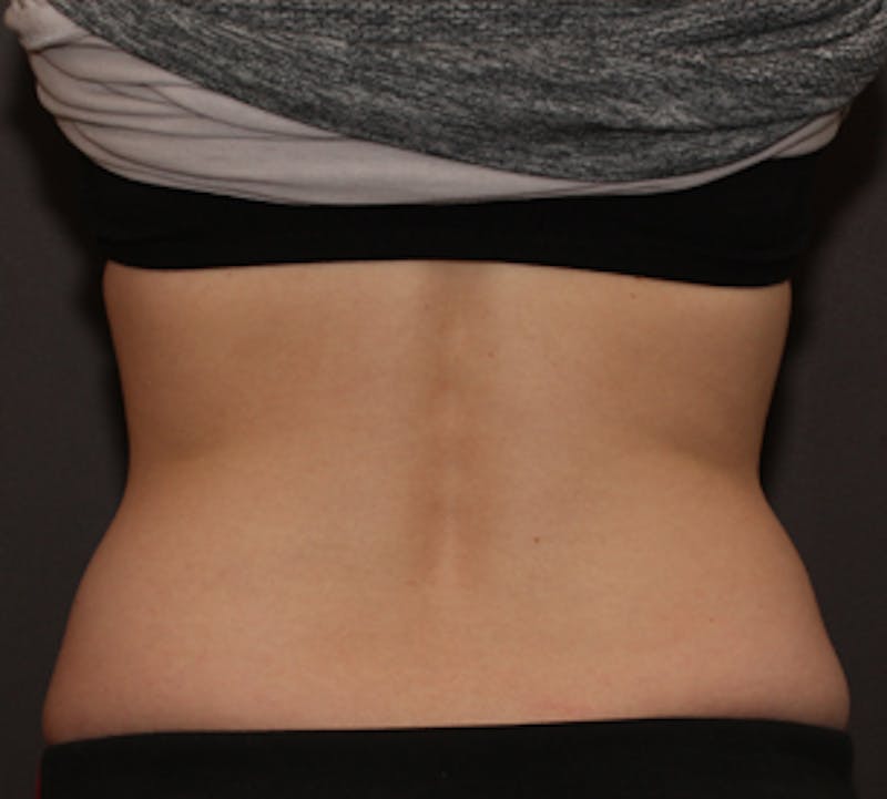 CoolSculpting® Before & After Gallery - Patient 3891434 - Image 3