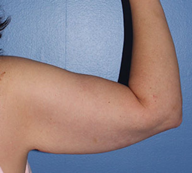 After Weight Loss Before & After Gallery - Patient 3891433 - Image 13
