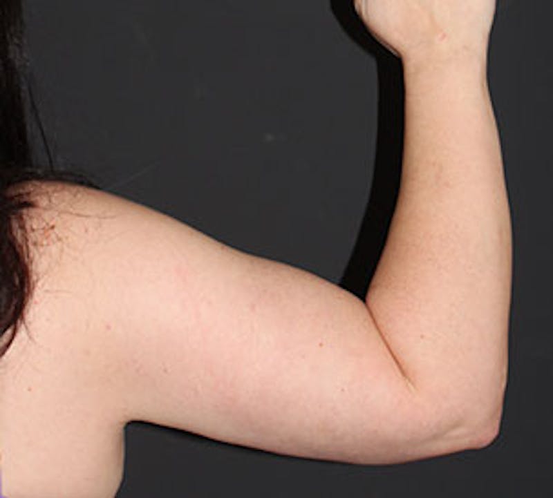 After Weight Loss Before & After Gallery - Patient 3891433 - Image 14