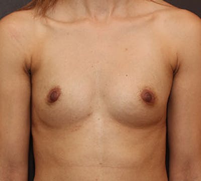 Breast Augmentation Before & After Gallery - Patient 3891438 - Image 1